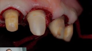 Создаем красивую улыбку за небольшие деньги . Коронки на зубы и циркония и протез на верхнюю челюст