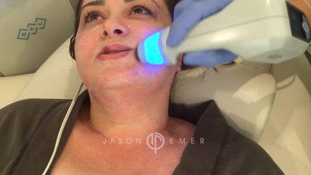 BTL Exilis Ultra | Neck Lift Skin Tightening | Cellulite Reduction | Beverly Hills смотреть онлайн