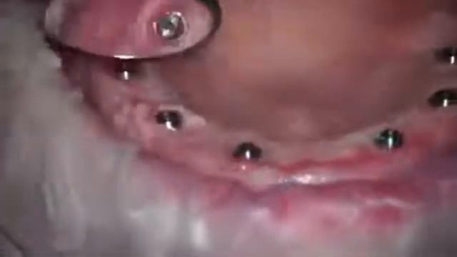 условно сьемный протез на имплантах смотреть онлайн