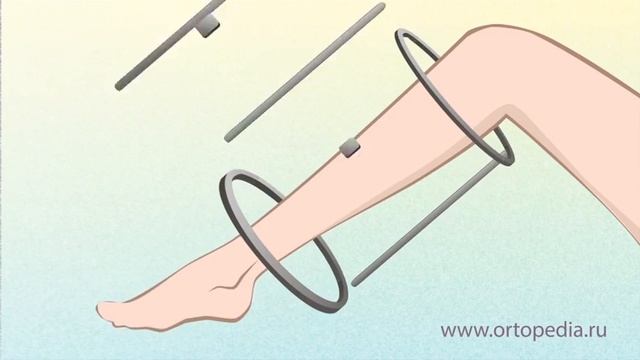 Исправление кривизны ног смотреть онлайн