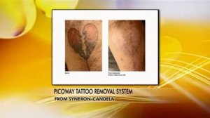 PicoWay Tatoo Removal System - Dr. Terrence Keaney on Let's Talk Live