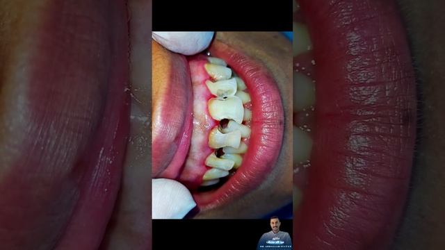 شوف اسنان البنوته دي قبل وبعد||composite restoration of anterior teeth #dr_abdullah_sultan_dentist