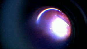 Старая отслойка сетчатки осложненная дислокацией ИОЛ