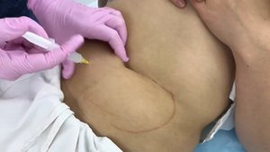 Инъекционный липолиз
