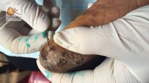 Черви в ножках Африканских детей