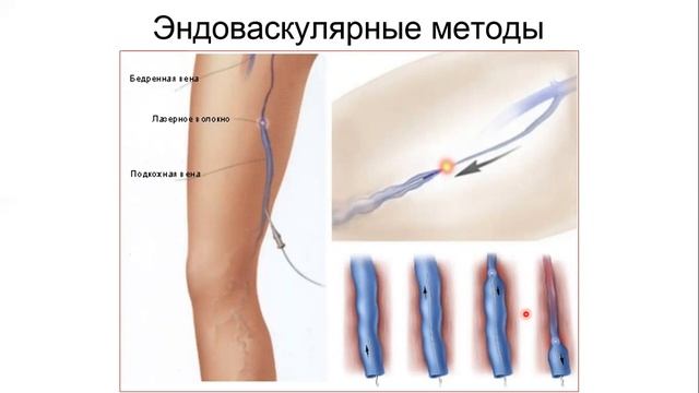 Варикозная болезнь, венозные тромбозы, посттромбофлебитический синдром