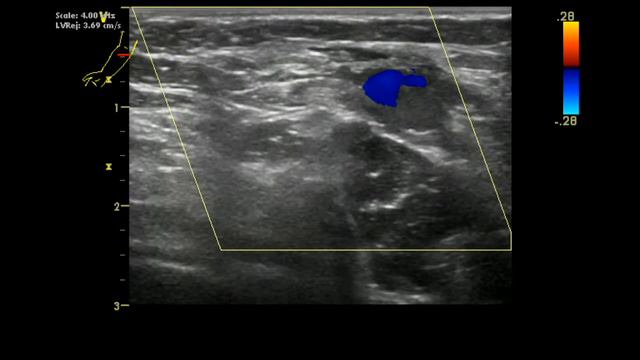 Сосудистое образование верхней конечности на УЗИ смотреть онлайн