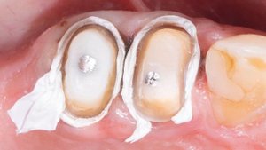 Стоматологическое сканирование