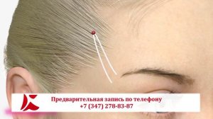 Нитевой лифтинг