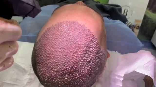 пересадка волос 5000 графтов смотреть онлайн