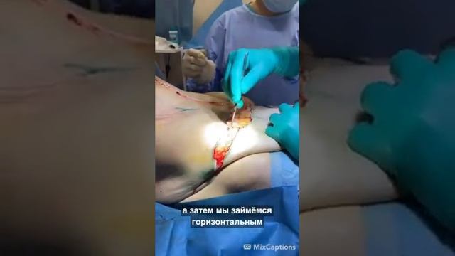 Абдоминопластика "Fleur de Lis" после значительной потери веса