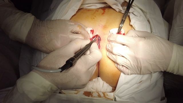 Киста копчика. Простая болезнь, простое лечение смотреть онлайн