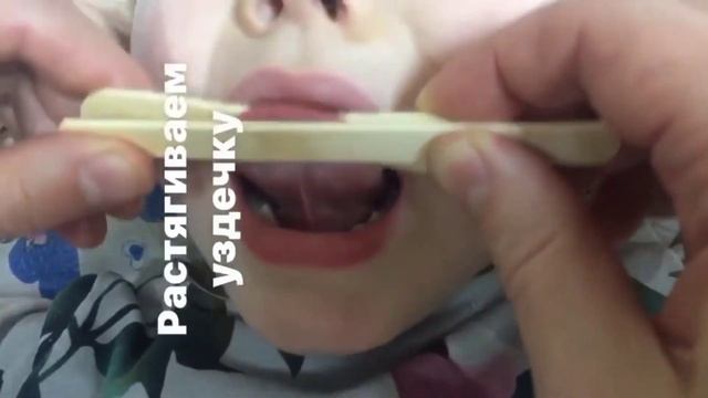 Как растянуть уздечку. logoped_stupenki