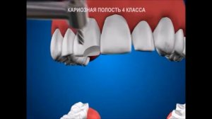 Лечение кариозных полостей 4 класса по Блеку. Стоматология.