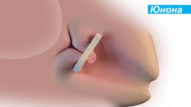 Введение акушерского пессария Юнона (Симург) смотреть онлайн