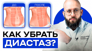 Что такое диастаз и как его определить. Методы лечения диастаза