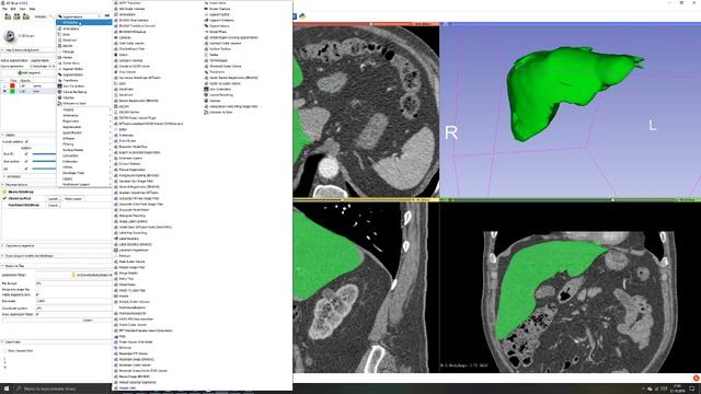 3D Slicer Tutorial #6: Computing segment volume смотреть онлайн