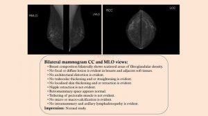 AbirEsha MPGR- Radiology and Imaging- S01 E04- Normal Mammography and Galactography Reports