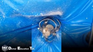 Преэндодонтический билдап 35 с глубоки разрушением дистальной стенки зуба ниже десны Белабонд 4K