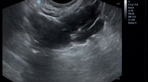 Эхогистеросальпингоскопия. Медикаментозный сактосальпинкс