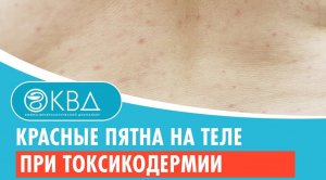 ? Красные пятна на теле при токсикодермии. Клинический случай №908