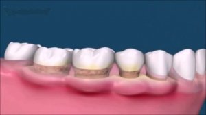 Что такое зубной камень и как его лечить