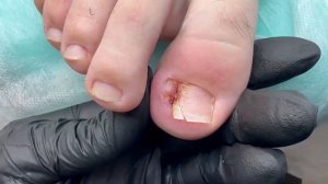 Вросший ноготь у ребенка | Динамика вросшего ногтя за 25 дней | Что делать, если болит ноготь?