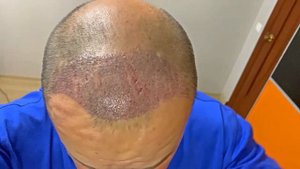 Снятие корочек с пересаженных волос в домашних условиях | 10 дней после трансплантации волос