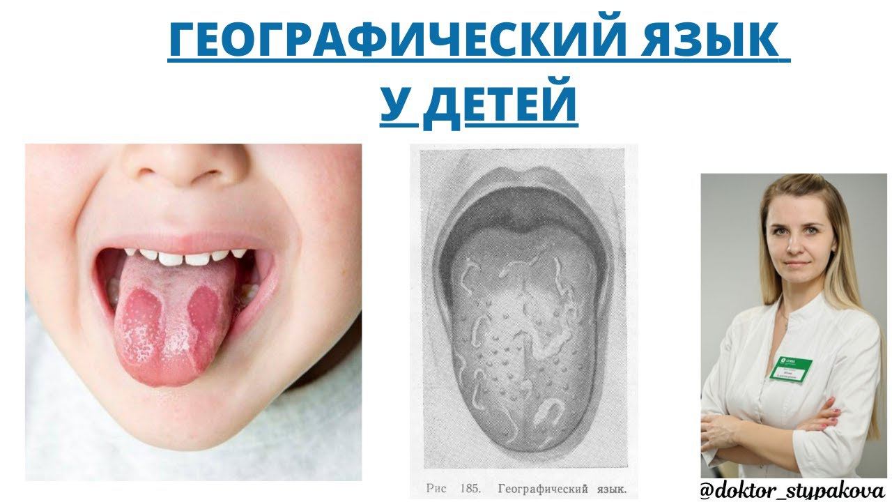 Географический язык. О каких заболеваниях свидетельствует данное состояние. Десквамативный глоссит. смотреть онлайн