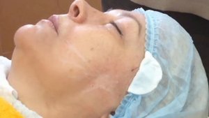 Обучающее видео по установке мезонитей