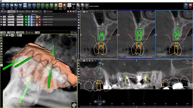 PlastiCad Разборный хирургический шаблон All-on-4 смотреть онлайн