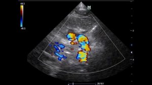 Правая дуга аорты