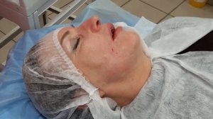 Меди-Лайт: Мезонити Торнадо, нижняя часть лица