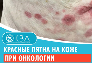 ? Красные пятна на коже при онкологии. Клинический случай №787