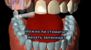Можно ли стоматит мазать зеленкой?