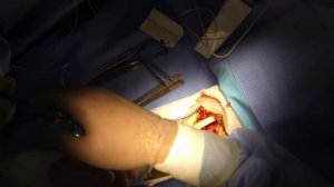 Single Incision Endobutton Biceps Tendon Repair