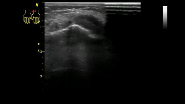 УЗИ проблемной кисти у женщины смотреть онлайн