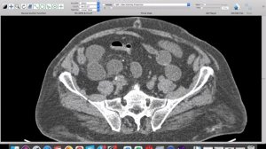 | GIT | IO | Trans-mesenteric internal hernia |