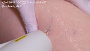 MD M22 удаление сосудов на теле и лице