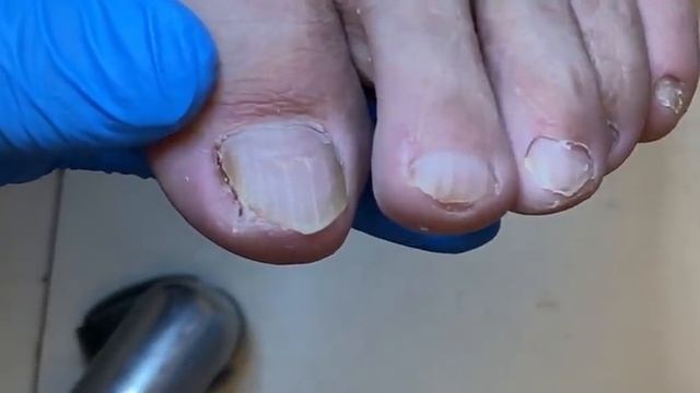 How to treat onychomycosis without removing nails【辥一刀】 смотреть онлайн