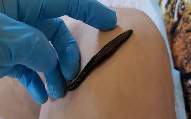 КАК САМОМУ ОДНОЙ РУКОЙ ПОСТАВИТЬ ЛЕЧЕБНЫЕ ПИЯВКИ!_НАТУРАЛЬНОЕ средство от тромбофлебит, для здоровья