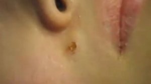 Удаление невуса на лице