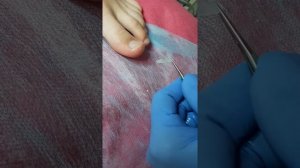 Установка BS-пластины (видео 2) - Эстетико-подологический центр Елены Басковой