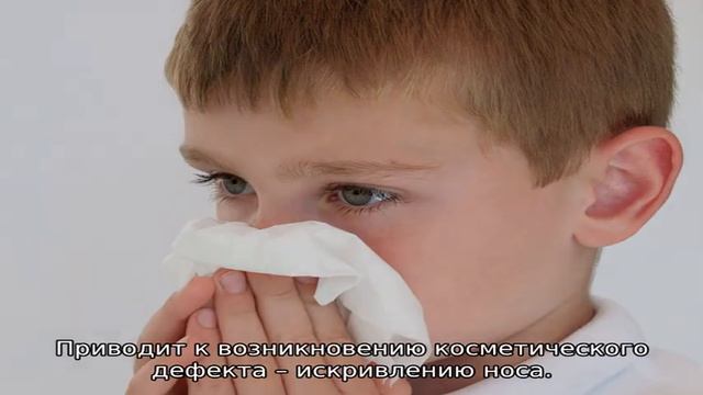 Признаки перелома носа у ребенка — как определить перелом