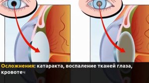 Витрэктомия