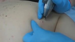 Удаления кондилом радиоволновым методом