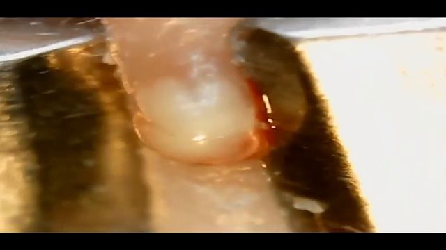 Pimple removal (прыщ удаление под микроскопом)
