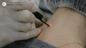 Лазерное удаление родинок, папиллом и новообразований