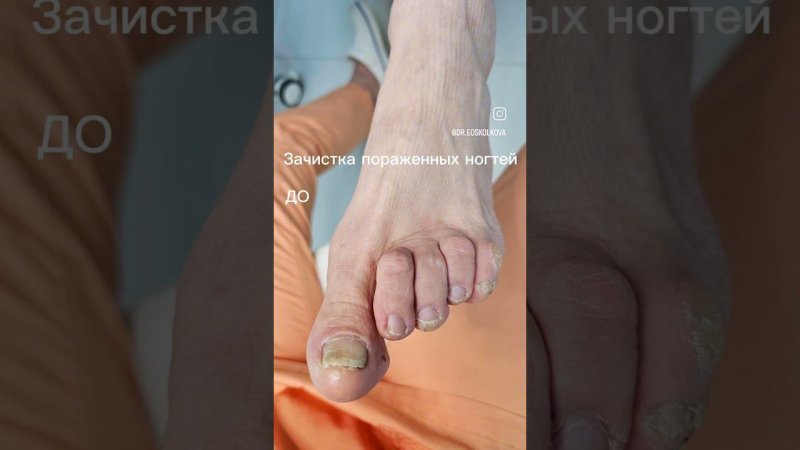 медицинский педикюр #shortsvideo #shortvideo #будниврача #тренды #доктор #dermatologia #podologia