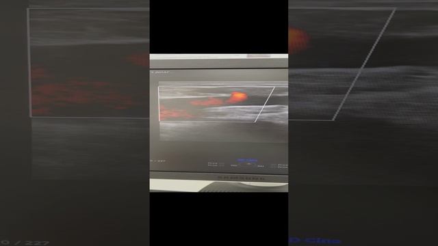 Варикоз у девушки. Как лечить варикоз? Узи сосудов. Флеболог Москва. Флеболог. Сосудистый центр смотреть онлайн